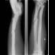 Fracture of the shaft of radius, secondary healing, malunion: X-ray - Plain radiograph